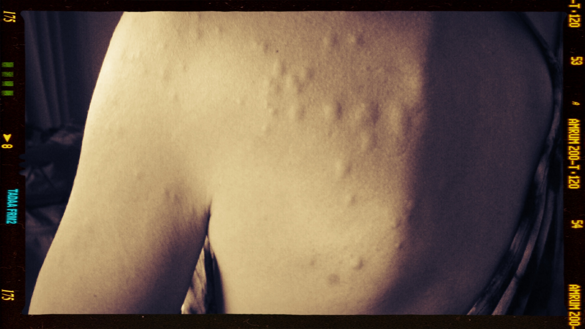 Blog Nine: Belly Full of Benadryl